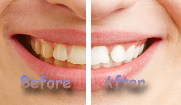 guideline for teeth whitening