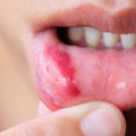are canker sores contagious