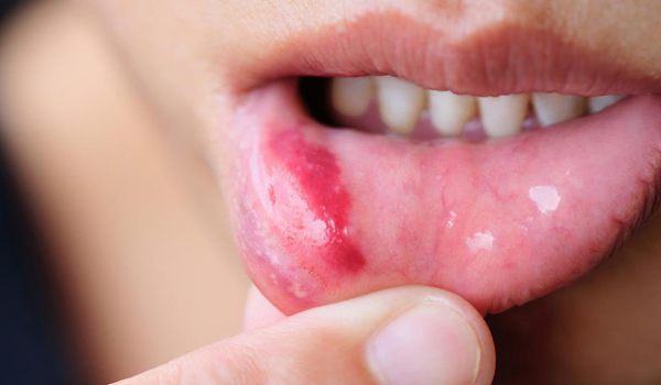 are canker sores contagious