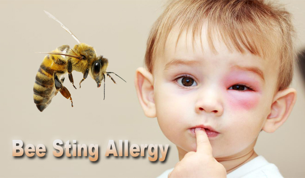 Bee Sting Allergy