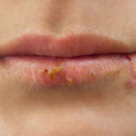 chapped lips treatment