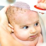 cradle cap in adults