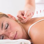 Acupuncture to Get Pregnant