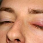 Chalazion and Bump on an Eyelid