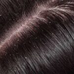 Scalp Sores and Scabs – Causes and Treatments