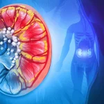 Kidney Stone Surgery