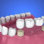 Wisdom Teeth Recovery