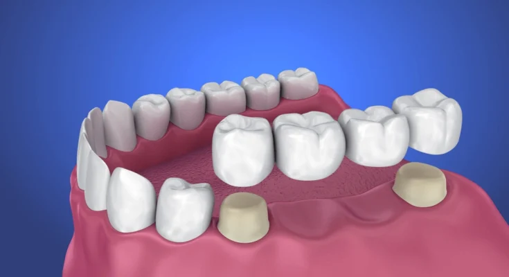 Wisdom Teeth Recovery Wisdom Teeth Recovery